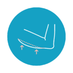 Veritas Plastic Surgery Walnut Creek BodyTite Arm Lift Veritas Plastic Surgery Walnut Creek BodyTite Arm Lift