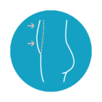 Veritas Plastic Surgery Walnut Creek BodyTite Tummy Tightening Veritas Plastic Surgery Walnut Creek BodyTite Tummy Tightening