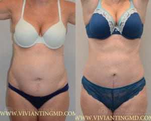 veritasplasticsurgery vivianting walnutcreek bodytite patient3b