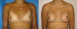 female after breast augmentation surgery